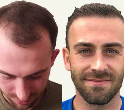 Hair Transplant Costs by Country Going Into Summer 2023